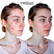 Вакуумний очищувач шкіри та пор Medica+ SKINCLEANER 7.0 MD-50116 фото 8