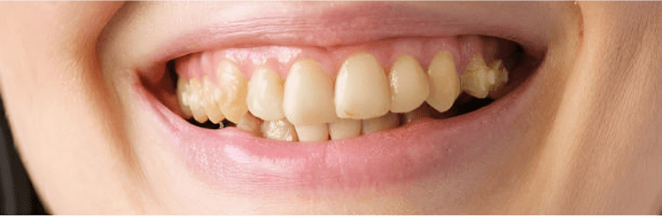 Відбілювальна піна для зубів Medica+ ToothMousse 5.0
